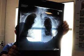 tumori piattaforma polmone per cure personalizzate e diagnosi precoce 2
