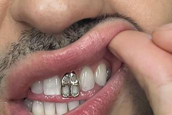 gioielli sui denti e grillz mania possibili rischi 2