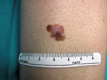 tumori contro melanoma il virus dellherpes modificato funziona lo studio 2