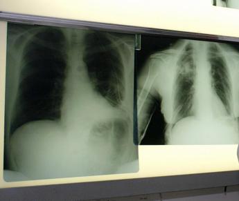 cancro polmone int e politecnico milano con msd per innovare gestione pazienti 2