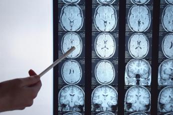 tumori per glioblastoma nuove prospettive da immunoterapia personalizzata 2