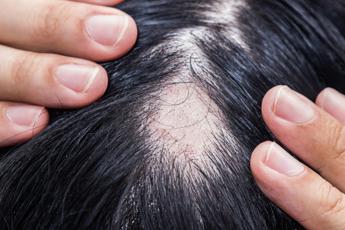 alopecia areata ok aifa a rimborsabilita nuovo trattamento 2