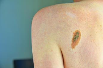 tumori 30 diagnosi melanoma in 2024 mai cosi tanti 2