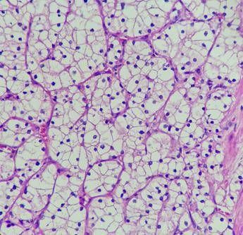 studio tki e immunoterapia piu efficace di sunitinib in carcinoma a cellule renali 2